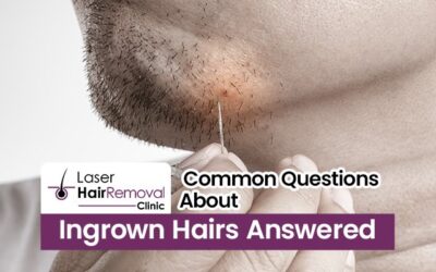 Common Questions About Ingrown Hairs Answered