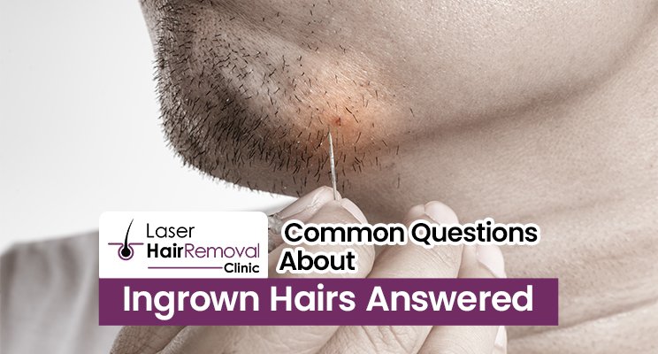 Common Questions About Ingrown Hairs Answered