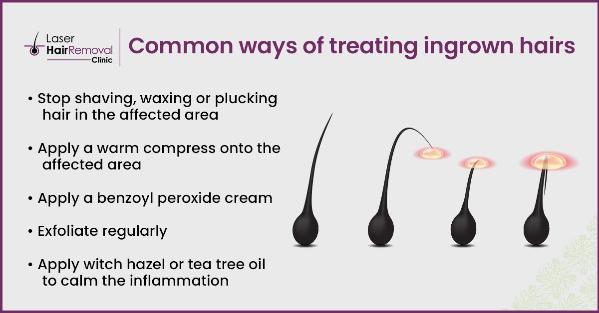 Treatment for Ingrown Hairs 