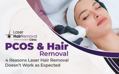 PCOS & Hair Removal: 4 Reasons Laser Hair Removal Doesn’t Work as Expected